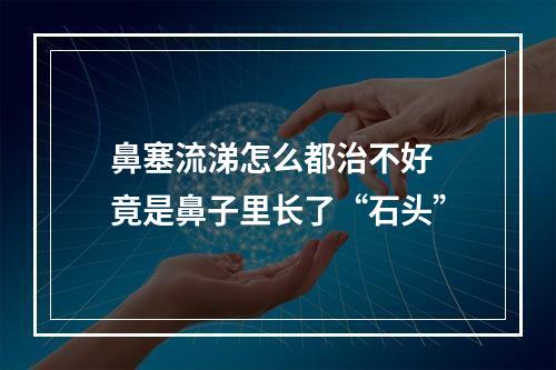 鼻塞流涕怎么都治不好 竟是鼻子里长了“石头”