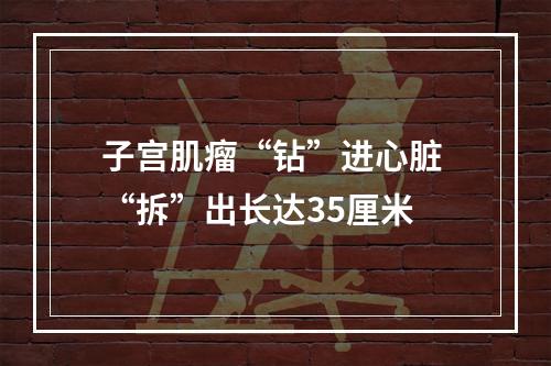 子宫肌瘤“钻”进心脏 “拆”出长达35厘米