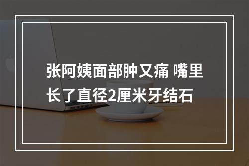 张阿姨面部肿又痛 嘴里长了直径2厘米牙结石