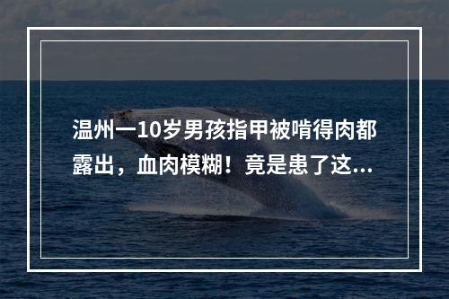 温州一10岁男孩指甲被啃得肉都露出，血肉模糊！竟是患了这种病…