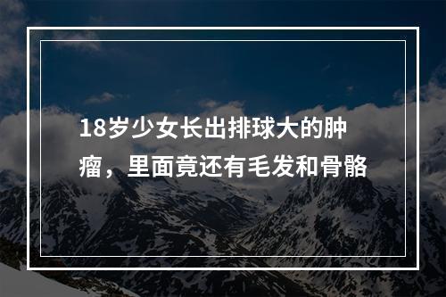 18岁少女长出排球大的肿瘤，里面竟还有毛发和骨骼